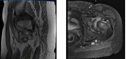 MRI Left hip non-contrast