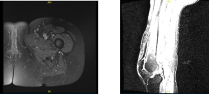 MRI Left thigh non-contrast