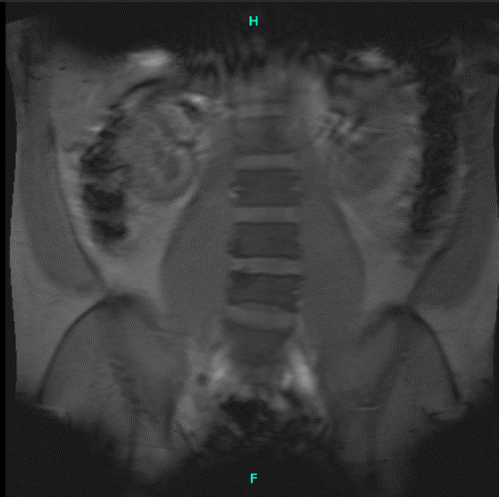 MRI Lumbar Spine non-contrast