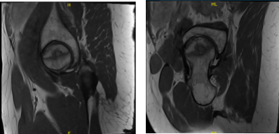 MRI Right hip non-contrast