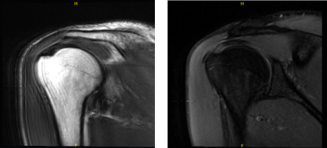 MRI Right shoulder non-contrast