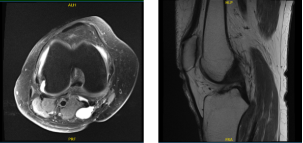 MRI of knee non-contrast