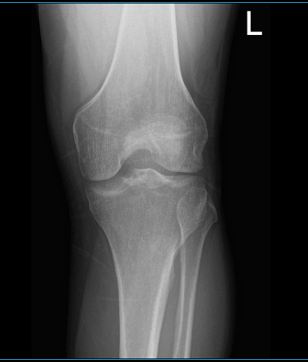 MRI of left knee