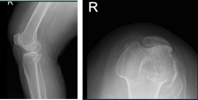 MRI of right knee