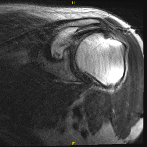 MRI of the left shoulder