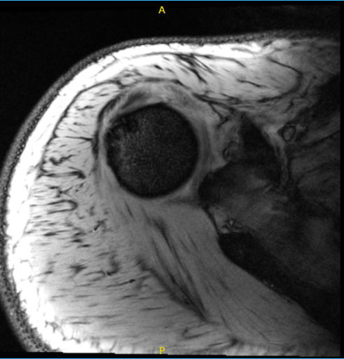 MRI of the right shoulder