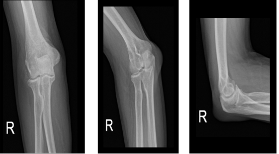 Right elbow x-ray