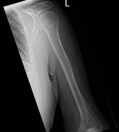 X-ray of the left shoulder