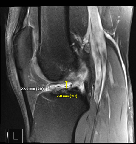 MRI of the right knee