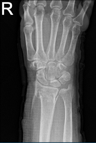 Right wrist X-ray 3 or more views