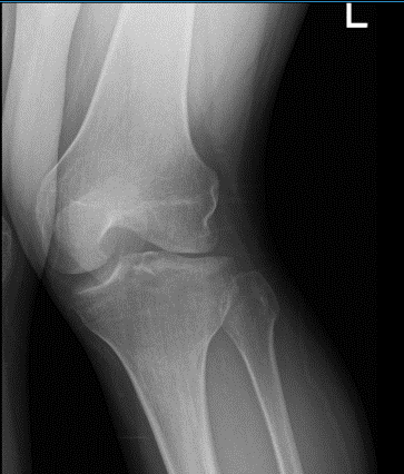 Left knee X-ray AP and Lateral with Oblique 3 views