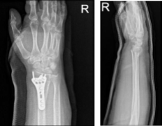 Right wrist x-ray 3 or more views