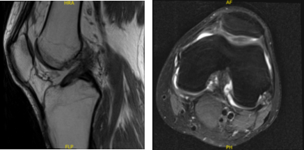 MRI-3T Left knee non-contrast