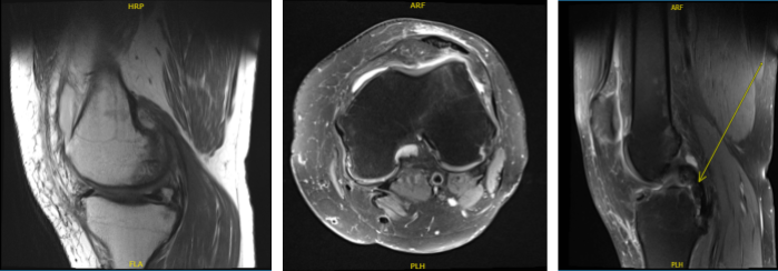 MRI of Left knee