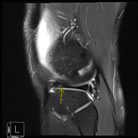 MRI of the right knee