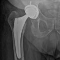 Hip Xray